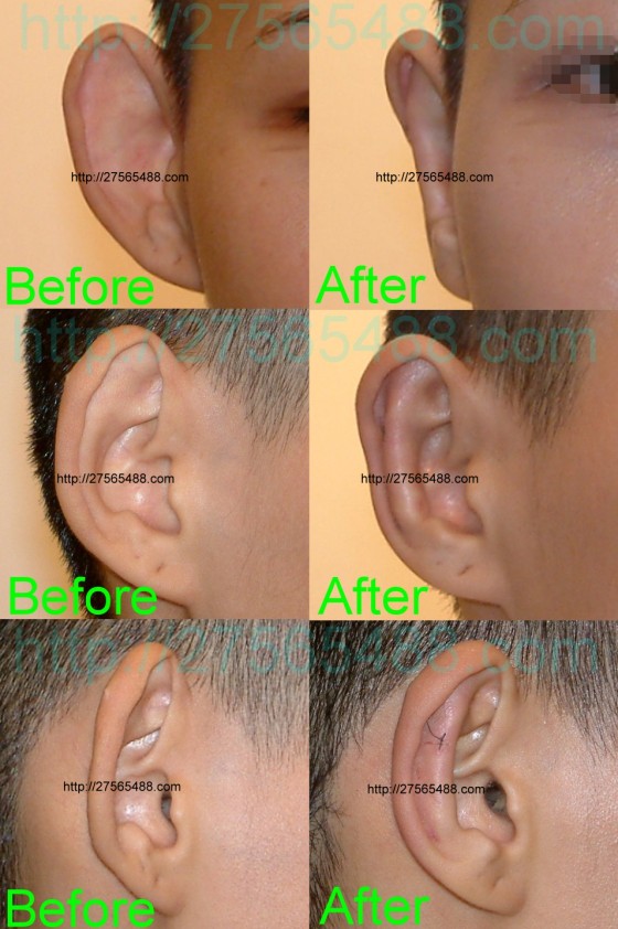 首页   左图:手术前照相 手术内容:经由耳朵后方小切口,矫正耳朵外翻