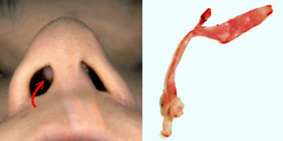 图一:曾经在其他院所以goretex 隆鼻后,goretex 突出於鼻孔外的情形