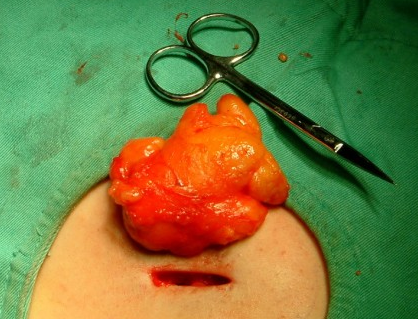 微创吸出脂肪瘤图片